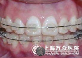 上海长宁区牙齿矫正哪家医院好 MBT牙齿矫正图