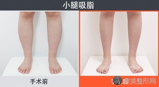 深圳小腿吸脂手术需要多久恢复？