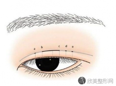 厦门割双眼皮术后的疤痕能自然退掉么