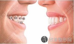 上海医院成人矫正牙齿 效果如何