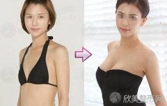 如何补救失败的假体隆胸手术