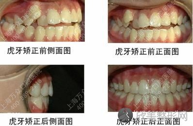 上海矫正牙齿多少钱