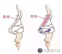 北京假体隆鼻失败如何修复呢？