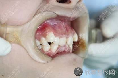 上海牙齿矫正过程