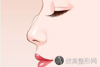 北京玻尿酸隆鼻要多少钱