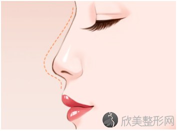 杭州线雕隆鼻术以后多久可以恢复好呢