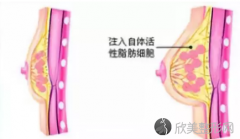 成都自体脂肪隆胸要注射几次才行呢