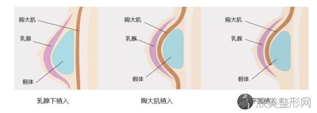 上海做自体脂肪隆胸手术安全不安全