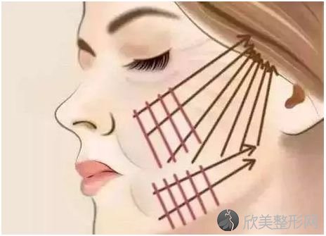 面部埋线提升的效果可以保持多少年