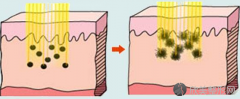 广州激光祛斑术一次性能完全消除吗