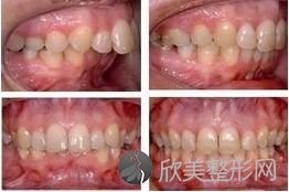 口腔医生解惑：龅牙矫正时间上有限制吗
