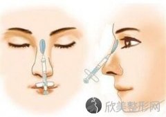 郑州打玻尿酸适应的隆鼻症状有哪些？