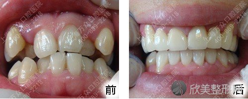 上海牙齿矫正医院 让您魅力无限(图)