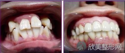 进行隐形牙齿矫正的过程中需要注意什么