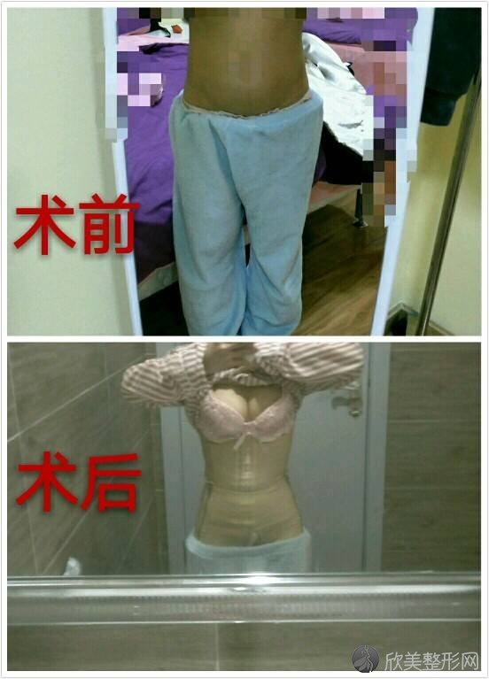 上海华美医疗美容医院李志海做脂肪丰胸怎么样？附医生简介-脂肪丰胸案例及
