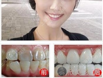 上海做牙齿矫正通常多少钱