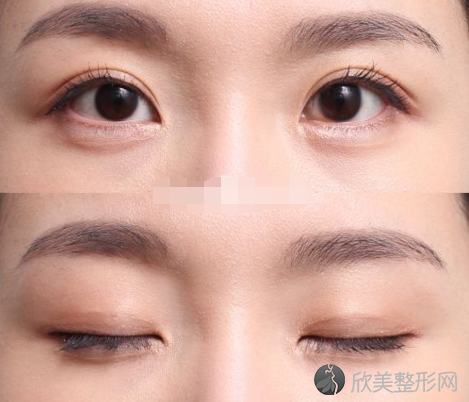 上海做全切双眼皮的肿胀淤青要多长时间才能消退呢