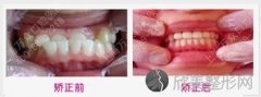做隐形矫正牙齿需要多少钱 影响因素多