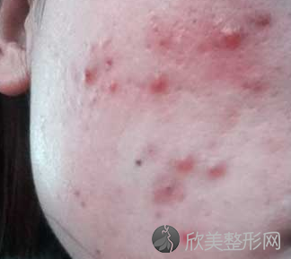 郑州激光祛痘恢复期是多长时间