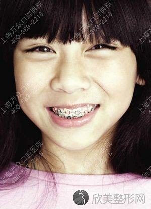 儿童牙齿矫正的最佳年龄是什么时候