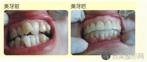 揭秘：上海比较好的龅牙矫正医院是哪里