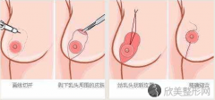 乳房下垂有些严重应该怎么办