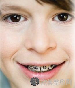 儿童做一次牙齿矫正的价格是多少
