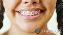 牙齿不整齐之牙齿矫正较佳年龄(图)