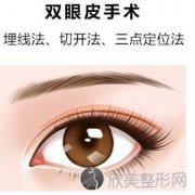 沈阳做双眼皮手术后恢复好不好