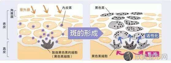 广州激光祛斑术后需要注意事项有哪些