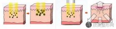 广州激光祛斑后怎样护理好呢