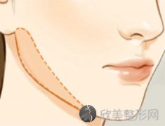 上海打玻尿酸丰下巴效果好吗