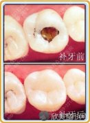 什么时候是儿童牙齿矫正的较佳年龄