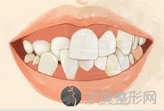 苏州隐形牙齿矫正好处有哪些