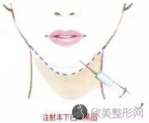 上海注射玻尿酸丰下巴效果怎么样