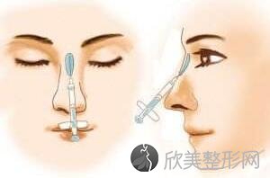北京玻尿酸隆鼻后会出现不良现象吗
