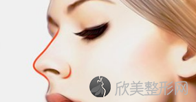 北京玻尿酸隆鼻后会出现不良现象吗