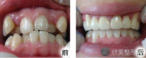上海蓝生万众医院牙齿矫正修复案例