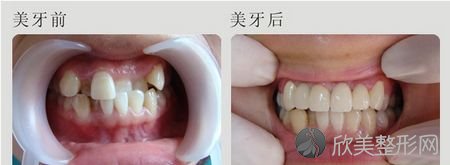 牙齿矫正的危害存在吗 应该如何避免