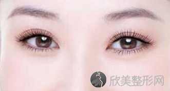 杭州做双眼皮手术大概需要多少钱