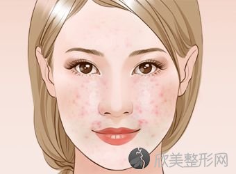 重庆祛除面部痘印方法有哪些