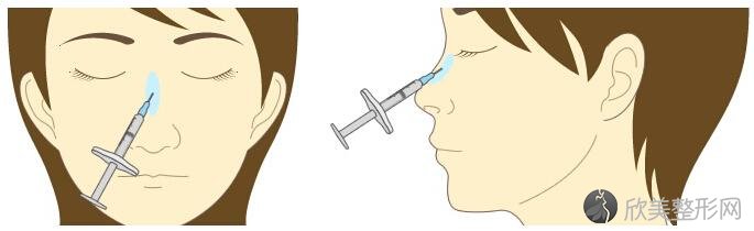 苏州玻尿酸隆鼻术后要怎么护理