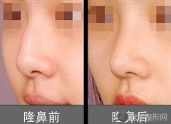 苏州玻尿酸隆鼻术后要怎么护理