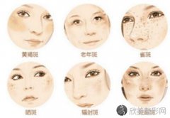 激光祛斑后的反黑时间长吗