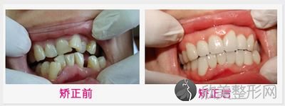 上海万众医生揭秘：牙齿隐形矫正需要多少钱