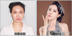 万州上眼皮下垂能做双眼皮手术吗