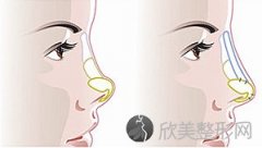 苏州线雕注射鼻一般价格是多少钱