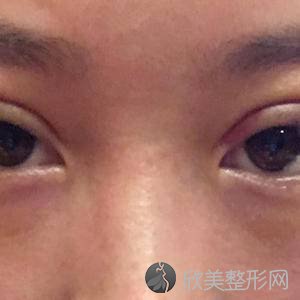 东营佐康专业袪痘旗舰店王奇伟做多点双眼皮怎么样？附医生简介-多点双眼皮