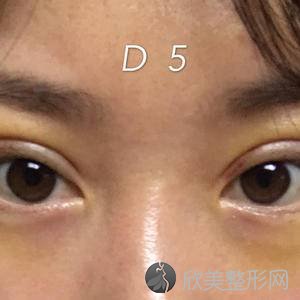 东营佐康专业袪痘旗舰店王奇伟做多点双眼皮怎么样？附医生简介-多点双眼皮