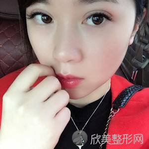 东营佐康专业袪痘旗舰店王奇伟做多点双眼皮怎么样？附医生简介-多点双眼皮